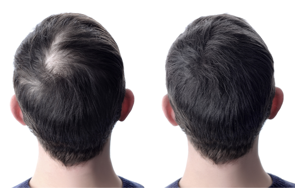 How to Make Minoxidil More Effective: Your Guide to Enhanced Hair Growth Results